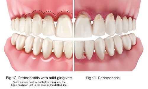 ADA illustration comparing gum disease and loss of supporting bone